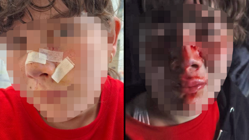 Pack of jackals attacks Sea of Galilee vacationers, sending 11 to hospital